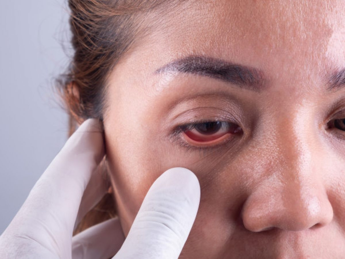 Konjungtivitis Alergi